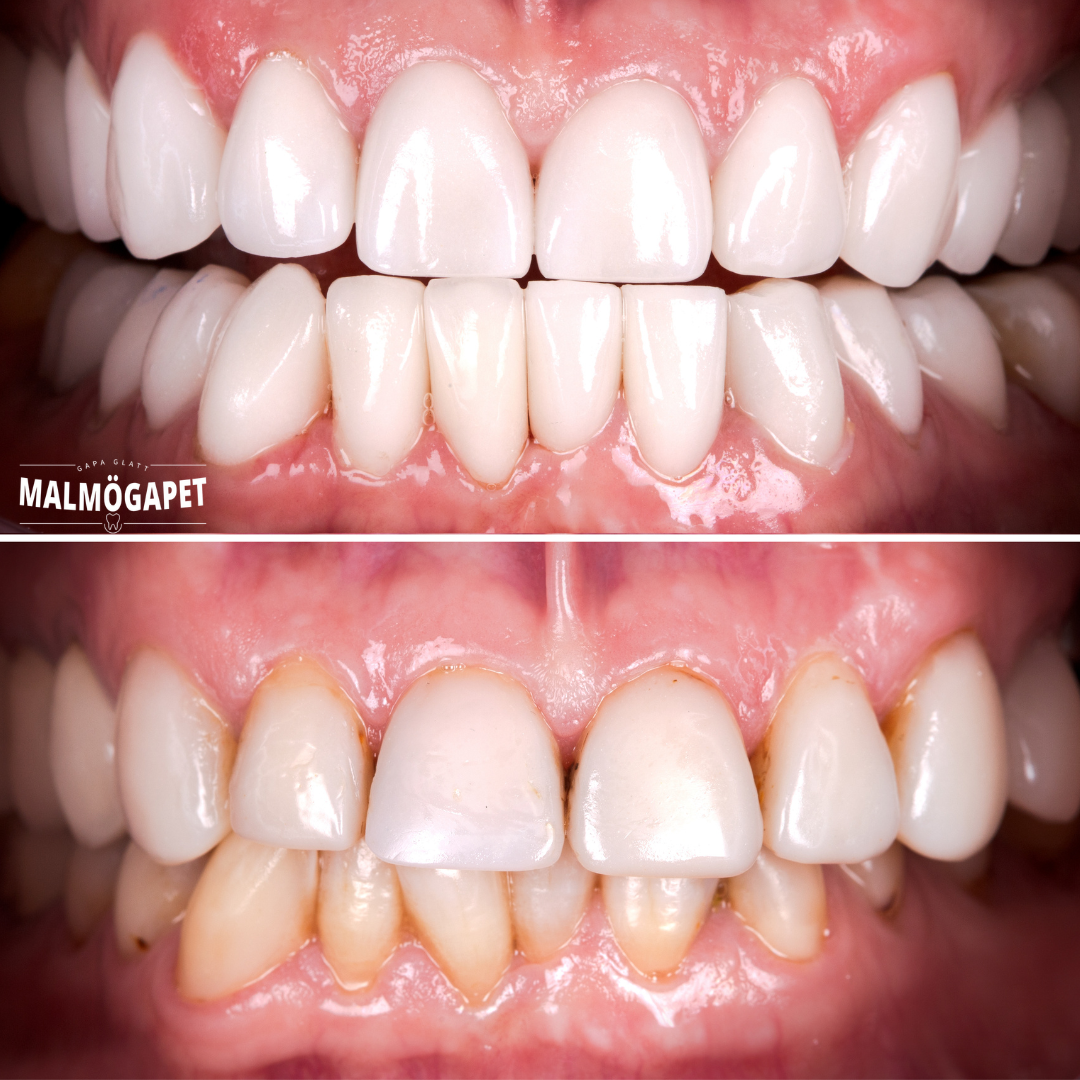 Före och efter – hela leendet återställt efter Invisalign