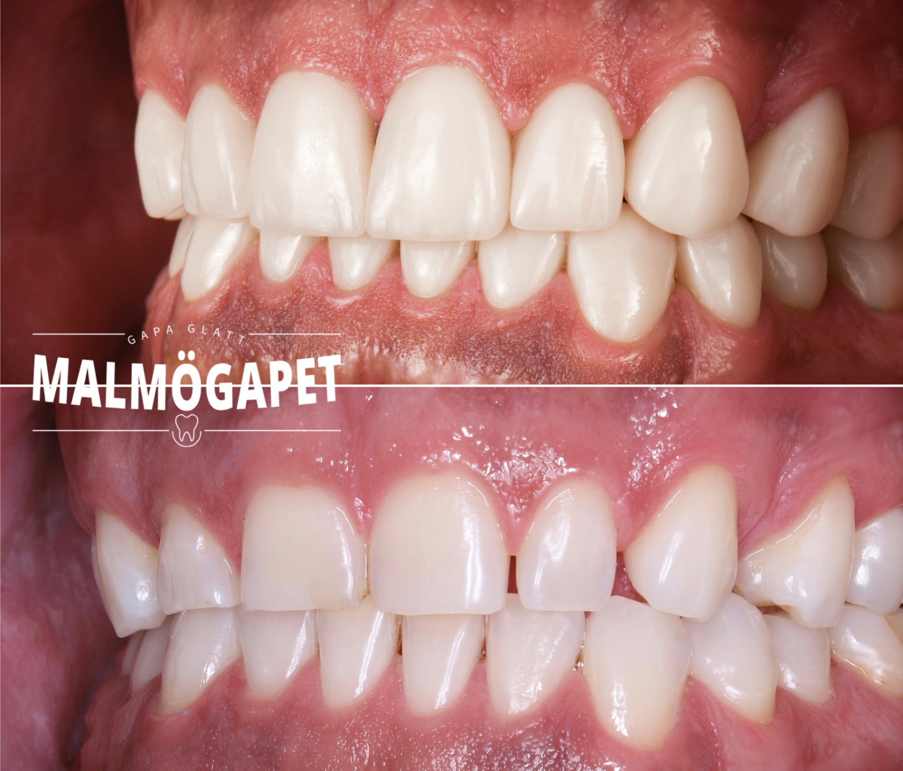 Före och efter – Invisalign kombinerat med tandblekning